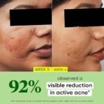 Dot & Key 2% Salicylic Acid + Cica Anti Acne Serum with Zinc | Salicylic Acid Serum for Acne and Dark Spots | Serum for Oily Acne Prone Skin & Sensitive Skin | Oil-Free & Non Comedogenic | 20 ml - Image 2