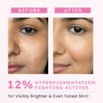 Hyphen Advanced De-Pigmentation Serum For Hyperpigmentation, Melasma, Dark Spots & Scars With 2% Kojic Acid | Visibly Brightens & Even Tones Skin | Serum For Women & Men - 30ml - Image 4