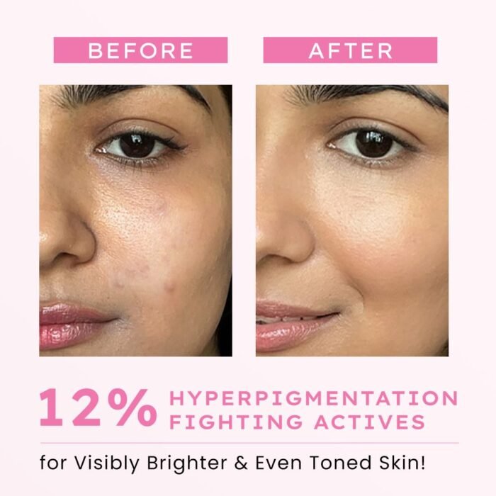 Hyphen Advanced De-Pigmentation Serum For Hyperpigmentation, Melasma, Dark Spots & Scars With 2% Kojic Acid | Visibly Brightens & Even Tones Skin | Serum For Women & Men - 30ml - Image 4