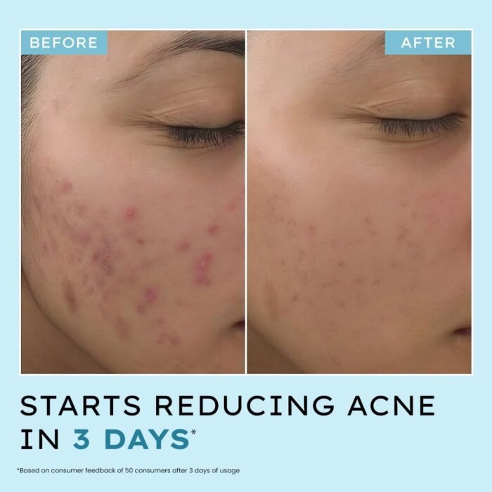 Hyphen Anti Acne 10% Azelaic Acid 2% Salicylic Acid Face Serum | 4% Niacinamide -Reduce Acne Marks, Fight Pimples | Tea Tree Extract -Soothes | Daily Serum for Women, Men | Oily, Acne Prone Skin -30ml - Image 5