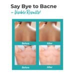 The Love Co 2% Salicylic Acid + Niacinamide Body Acne Spray | For Back Acne (Bacne), Chest & Shoulders | Helps Unclog Pores & Control Breakouts | For Clearer-Looking Skin | Non-Sticky Spray | 100ml - Image 4