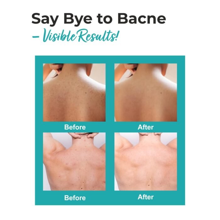 The Love Co 2% Salicylic Acid + Niacinamide Body Acne Spray | For Back Acne (Bacne), Chest & Shoulders | Helps Unclog Pores & Control Breakouts | For Clearer-Looking Skin | Non-Sticky Spray | 100ml - Image 4