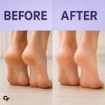 Carbamide Forte 20% Urea Foot Cream Roll-On 50ml | Foot roll on for cracked heels | With Lactic Acid, Shea Butter & Olive Oil | Helps Repair, Exfoliate & Moisturise Cracked Heels - Image 7