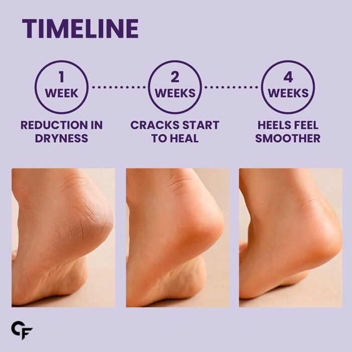 Carbamide Forte 20% Urea Foot Cream Roll-On 50ml | Foot roll on for cracked heels | With Lactic Acid, Shea Butter & Olive Oil | Helps Repair, Exfoliate & Moisturise Cracked Heels - Image 8