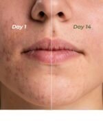 Indus Valley Calming Acne Gel with Seaweed Extract & Tea Tree Oil for Pimples, Soothes, Clarifies, and Refreshes Skin Naturally – 30ml - Image 8