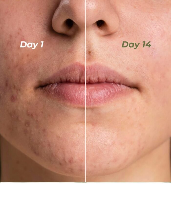 Indus Valley Calming Acne Gel with Seaweed Extract & Tea Tree Oil for Pimples, Soothes, Clarifies, and Refreshes Skin Naturally – 30ml - Image 8